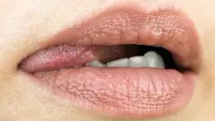 انفیکشن، سیکس