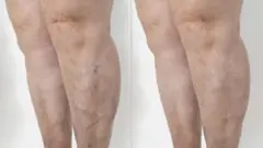 පාදවල ගැට ගැසුනු, ඉහළට නෙරා ඇවිත් ඇති සහ නිල් පැහැති නහර දකින බොහෝ අය සිතන්නේ එය හුදෙක් රූපලාවන්‍ය ගැටලුවක් බවයි