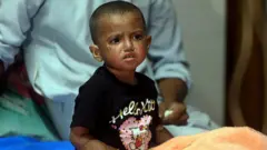 হাসপাতালে চিকিৎসাধীন হামে আক্রান্ত শিশু