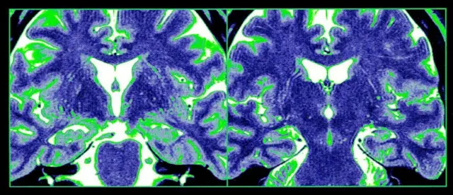 Normal bir hipokampus'un MR çekimi.