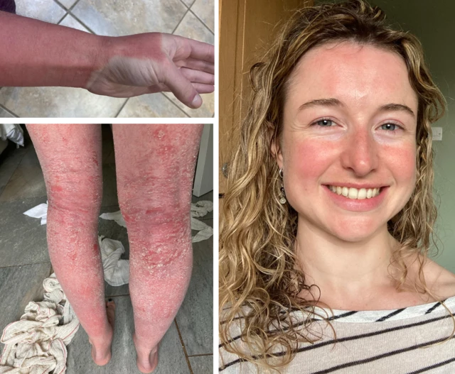 왼쪽에는 제나 크로스비의 다리와 팔이 심하게 붉어지고 물집이 생기며 피부가 벗겨지는 모습이 담겨 있다. 오른쪽에서는 피부 상태가 훨씬 나아진 모습으로 미소를 짓고 있다.