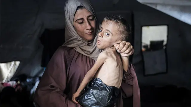 Mère portant un jeune garçon qui a perdu le tiers de son poids corporel à cause de la malnutrition