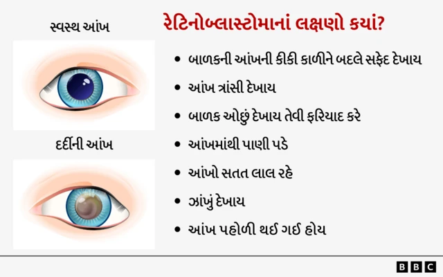 બાળકોમાં થતી આંખની રેટિનોબ્લાસ્ટોમા બીમારી શું છે, રેટિનોબ્લાસ્ટોમાથી બચવા શું કરવું, રેટિનોબ્લાસ્ટોમાના લક્ષ્ણ, બીબીસી ગુજરાતી ન્યૂઝ સાથે સમજો, બીબીસી ગુજરાતી સમાચાર